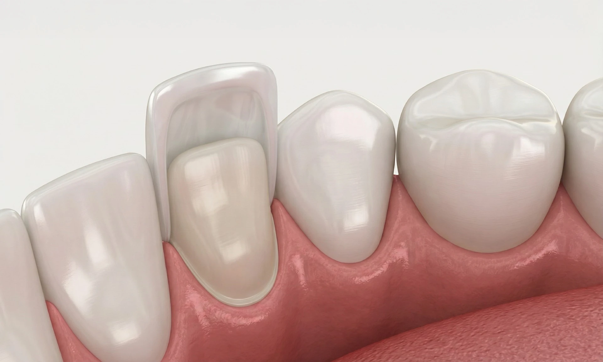 What Are Porcelain Veneers?